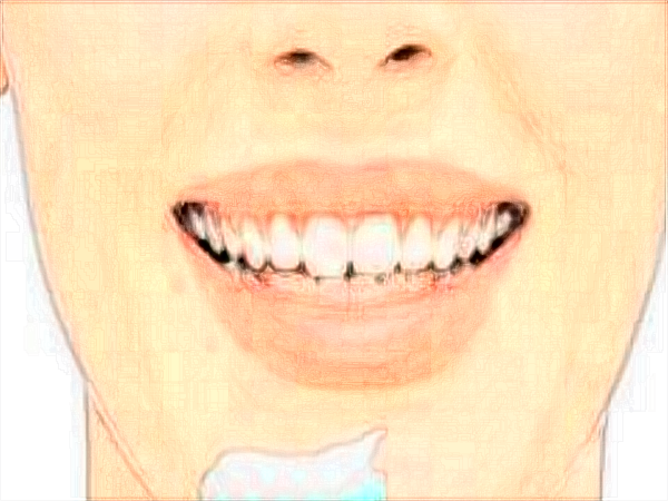 中山大學(xué)附屬口腔醫(yī)院洗牙怎么樣?洗牙對(duì)牙齒有傷害嗎