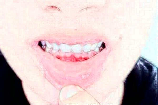 天津醫(yī)科大學(xué)口腔醫(yī)院鑲牙怎么樣_哪位醫(yī)生技術(shù)比較好