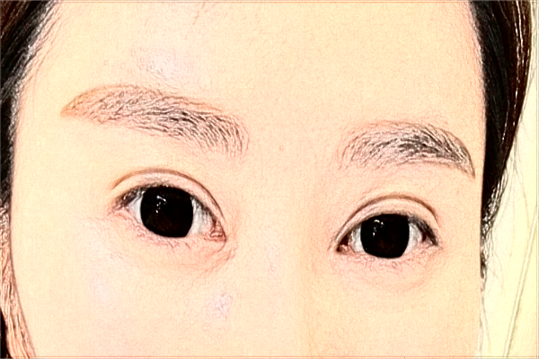 保定市第一中心醫(yī)院割雙眼皮怎么樣_哪位醫(yī)生比較好