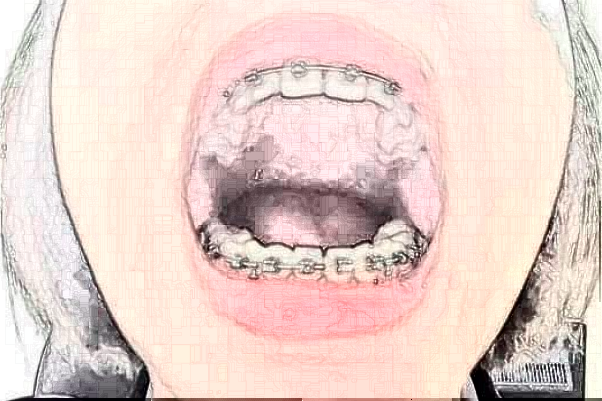 南京中大醫(yī)院口腔科牙齒修復(fù)做的好嗎?體驗(yàn)日記分享