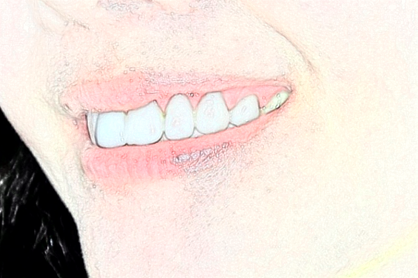 大連中山醫(yī)院口腔科單顆牙種植可以做嗎?做的好不好