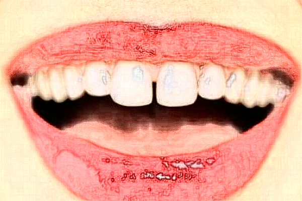 天津醫(yī)科大學(xué)第二醫(yī)院口腔科拔智齒大概多少錢?實測案例分享