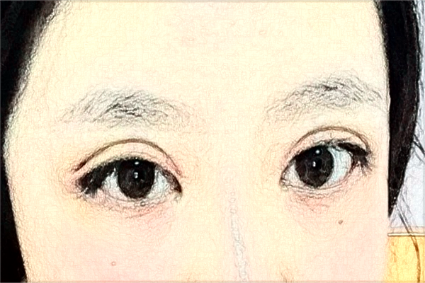 溫州醫(yī)學(xué)院附屬第一醫(yī)院做雙眼皮怎么樣_大概需要多少錢