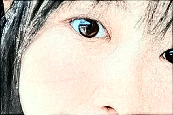 江蘇大學(xué)附屬醫(yī)院激光洗眼線怎么樣?實(shí)測(cè)案例分享