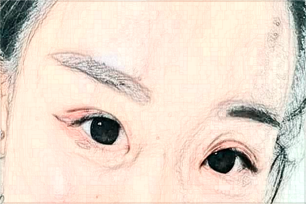 江蘇大學(xué)附屬醫(yī)院激光洗眼線怎么樣?實(shí)測(cè)案例分享