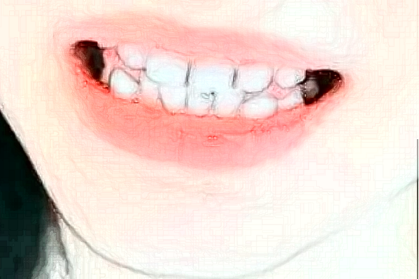 2024天津醫(yī)科大學(xué)第二醫(yī)院口腔科口腔修復(fù)價格嘗鮮版_體驗日記分享