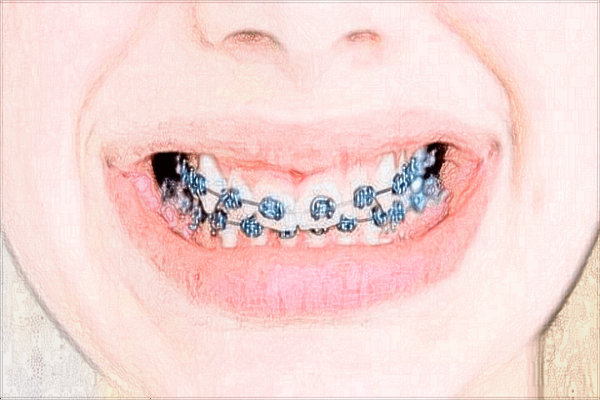 2024青島市立醫(yī)院正畸費用?正畸和矯正有什么區(qū)別