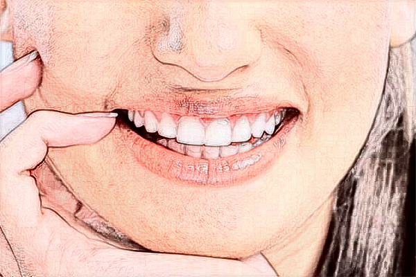 2024中山大學(xué)附屬口腔醫(yī)院瓷貼面費(fèi)用?瓷貼面能保持多久