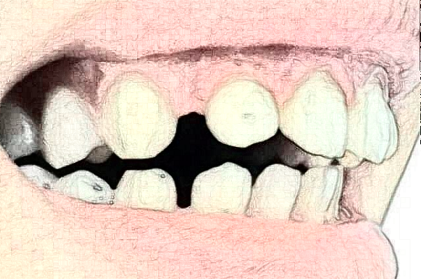 天津醫(yī)科大學(xué)第二醫(yī)院口腔科烤瓷冠怎么樣_哪個(gè)醫(yī)生比較好