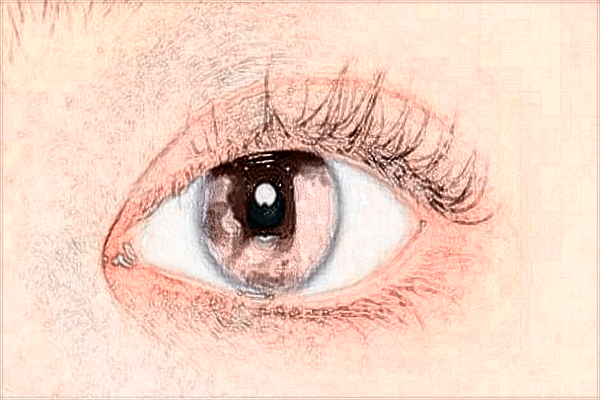 2024貴陽醫(yī)學(xué)院附屬醫(yī)院全飛秒手術(shù)價(jià)格?全飛秒手術(shù)原理