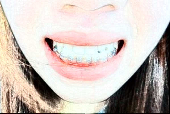 天津醫(yī)科大學(xué)總醫(yī)院口腔科口腔修復(fù)做的好嗎?整形日記分享