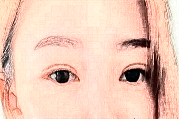 2024寧波李惠利醫(yī)院割雙眼皮怎么樣_案例+價(jià)格