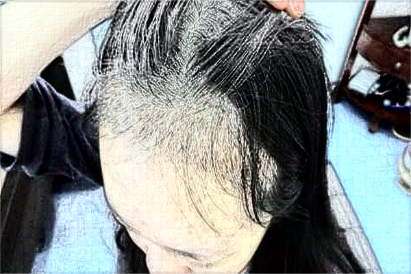 南通大學(xué)附屬醫(yī)院植發(fā)做的好嗎？誰做的好