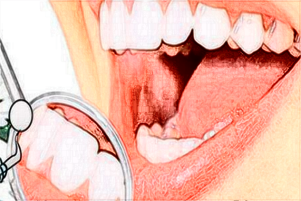 2024中山大學(xué)附屬第三醫(yī)院補牙怎么樣?補牙材料是什么