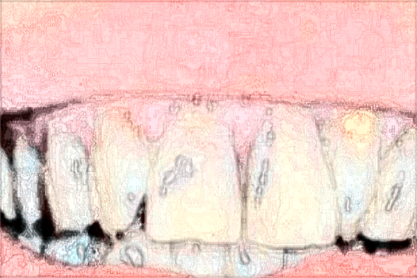 2024中山大學(xué)附屬第三醫(yī)院牙齒矯正多少錢?牙齒矯正需要多久