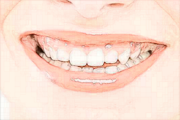 2024中山大學(xué)附屬口腔醫(yī)院種植牙齒多少錢?種植牙齒利弊