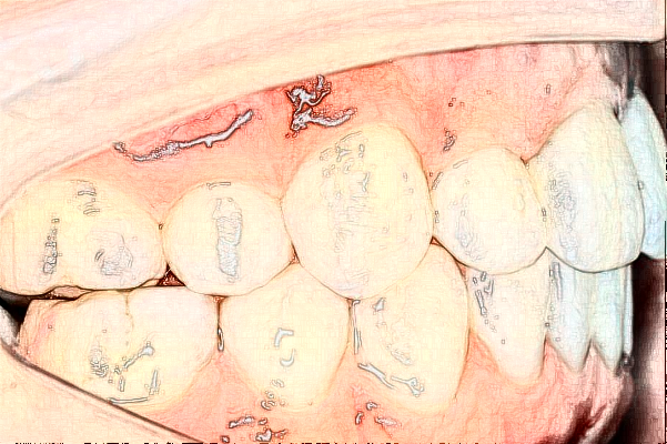 南通大學(xué)附屬醫(yī)院隱形正畸做的好嗎？誰做的好