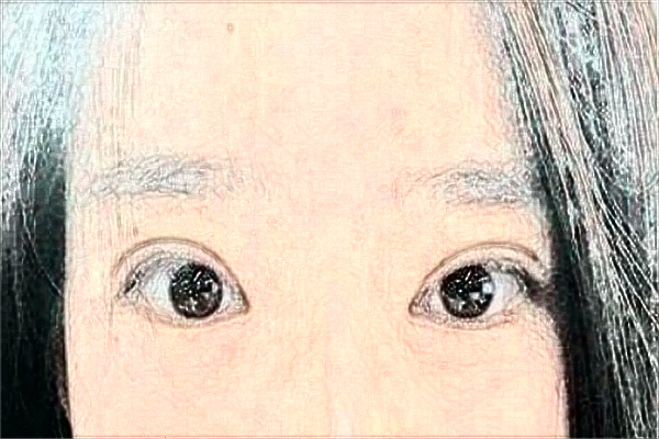 2024大連醫(yī)科大學(xué)附屬第一醫(yī)院做雙眼皮做的好嗎_醫(yī)生技術(shù)好不好