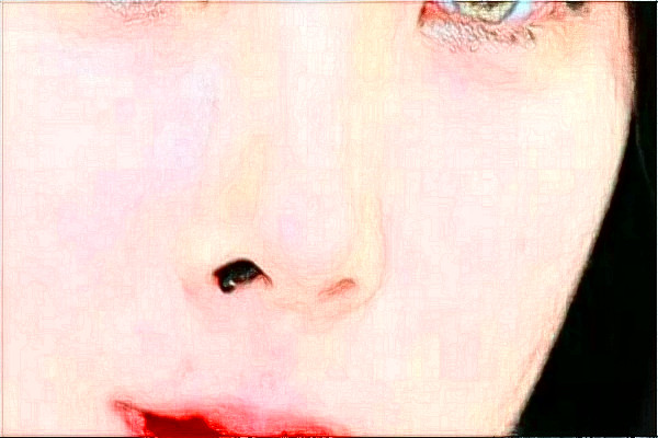 2024天津醫(yī)科大學總醫(yī)院可以去胎記嗎？去胎記真實案例