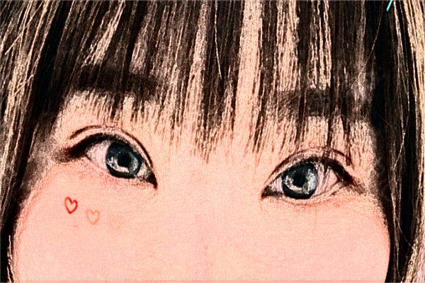 2024大連醫(yī)科大學附屬第一醫(yī)院做雙眼皮做的好嗎?整形日記分享