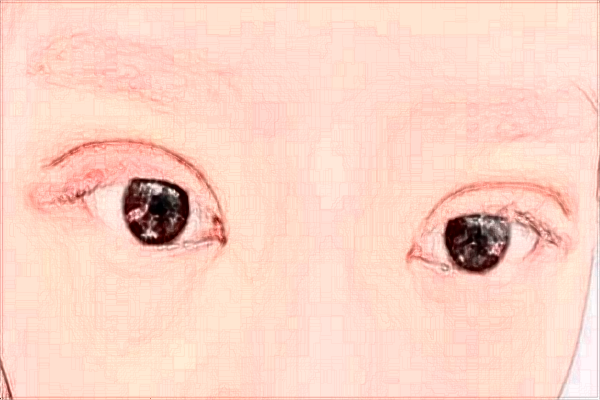 天津醫(yī)科大學(xué)總醫(yī)院割雙眼皮做的怎么樣_哪位醫(yī)生技術(shù)比較好