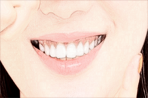 佛山市第二人民醫(yī)院牙科好嗎?2024牙科種植牙收費標準?