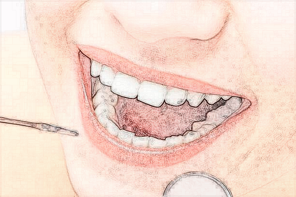 2024海口市人民醫(yī)院正畸費(fèi)用?牙齒矯正有必要嗎?