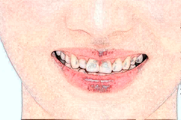 丹東市第一醫(yī)院種植牙做的怎么樣_誰做得好