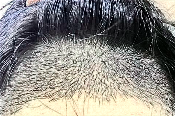 溫州醫(yī)學(xué)院附屬第二醫(yī)院植發(fā)價(jià)格表_醫(yī)生推薦