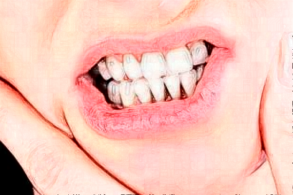 溫州醫(yī)學(xué)院附屬第二醫(yī)院口腔科烤瓷牙做的怎么樣_誰(shuí)做的比較好