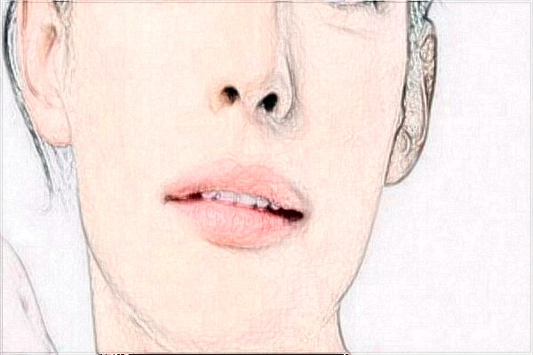 無錫市第一人民醫(yī)院激光祛斑做的怎么樣【激光祛斑全新案例】