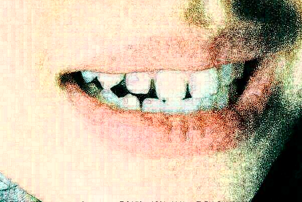 南京中大醫(yī)院口腔科美容修復(fù)價(jià)目表(價(jià)格表)口碑怎么樣