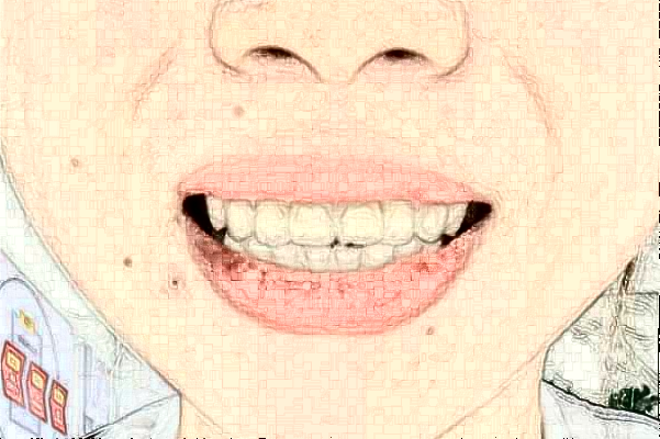 2024蘇北人民醫(yī)院牙齒正畸怎么樣?全新案例分享