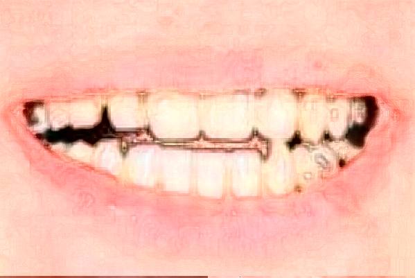 2024天津醫(yī)科大學(xué)總醫(yī)院口腔科牙列不齊矯正怎么樣