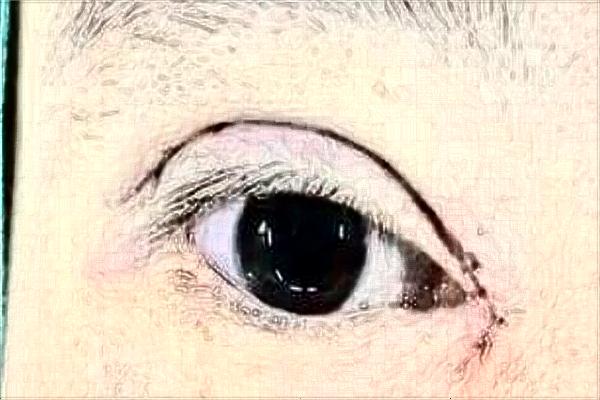 無錫市第一人民醫(yī)院割雙眼皮做的怎么樣_誰做的比較好