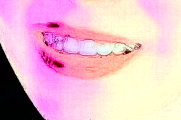 大連大學(xué)附屬新華醫(yī)院牙列擁擠矯治怎么樣?全新案例分享