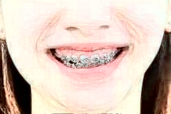 蘇北人民醫(yī)院牙齒美白價(jià)目表_口碑怎么樣