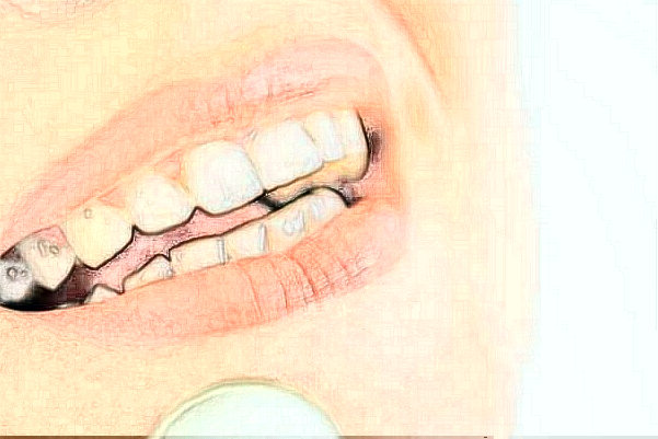 2024天津海河醫(yī)院單顆牙種植價(jià)目表(價(jià)格表)怎么樣