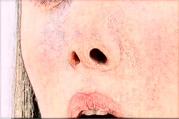 常德市第—人民醫(yī)院祛雀斑掛什么科?激光祛斑會不會反彈?