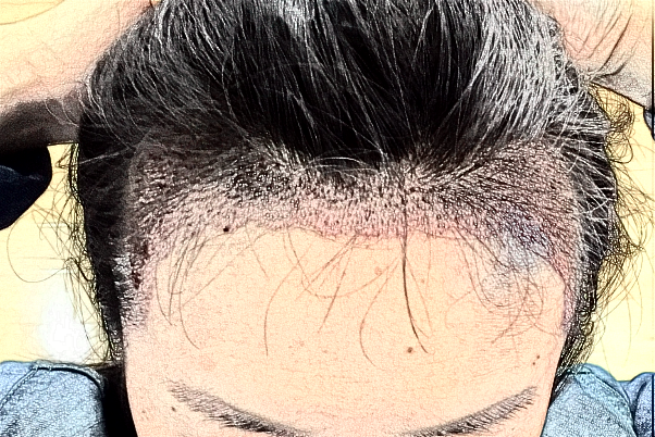 2024蘭州大學(xué)第二醫(yī)院植發(fā)多少錢?植發(fā)后還會(huì)脫落嗎