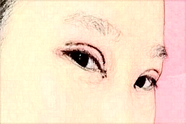 2024安徽省立醫(yī)院開眼角怎么樣_誰做得好