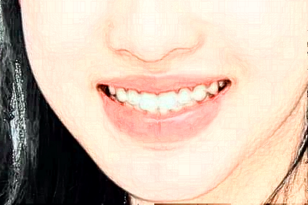 ?？谑腥嗣襻t(yī)院補牙哪個醫(yī)生好?補牙案例