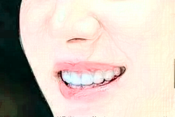 ?？谑腥嗣襻t(yī)院補牙哪個醫(yī)生好?補牙案例