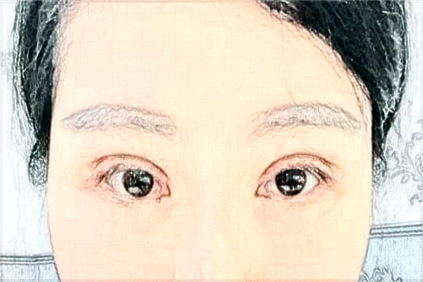 2024沈陽盛京醫(yī)院割雙眼皮醫(yī)生名單_案例分享