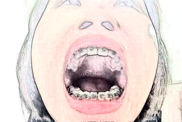 江蘇省人民醫(yī)院牙列不齊矯正怎么樣_誰做得好