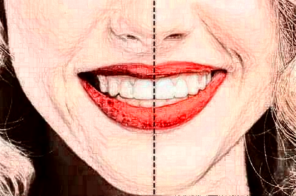 上海華美醫(yī)療美容醫(yī)院樹(shù)脂補(bǔ)牙價(jià)目(價(jià)格)表_怎么樣