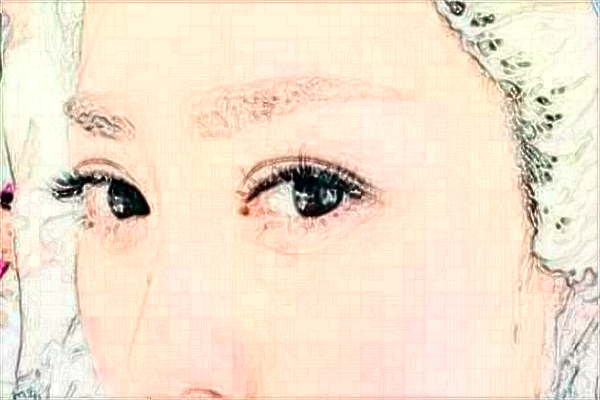 徐州醫(yī)科大學附屬醫(yī)院開眼角怎么樣_整形日記分享