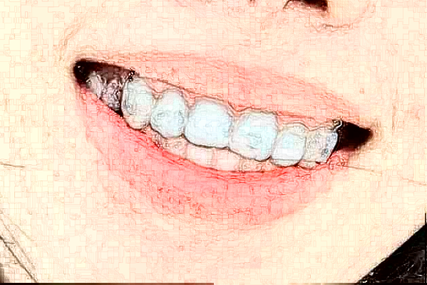 海口市人民醫(yī)院種植牙怎么樣?種植牙有后遺癥嗎