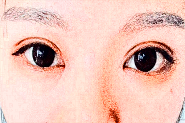 煙臺毓璜頂醫(yī)院整形美容科誰做鼻子做得好?隆鼻案例