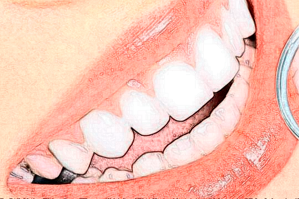 2024上海華美醫(yī)療美容醫(yī)院牙齒正畸費(fèi)用多少_真實(shí)案例反饋